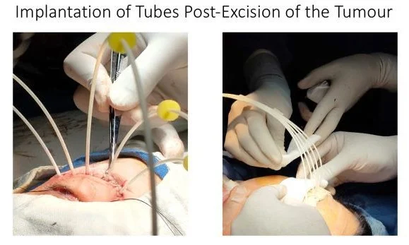 Ocular Oncology Treatment Case 2