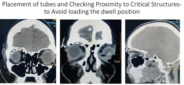 Ocular Oncology Treatment Case 1