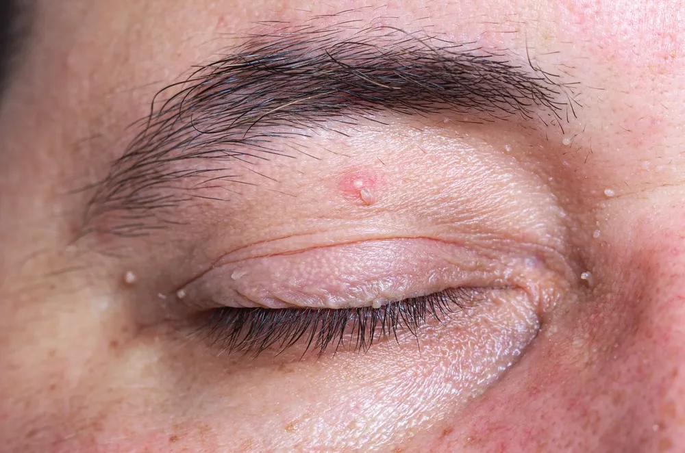 Eyelid Cancer Treatment in Hyderabad