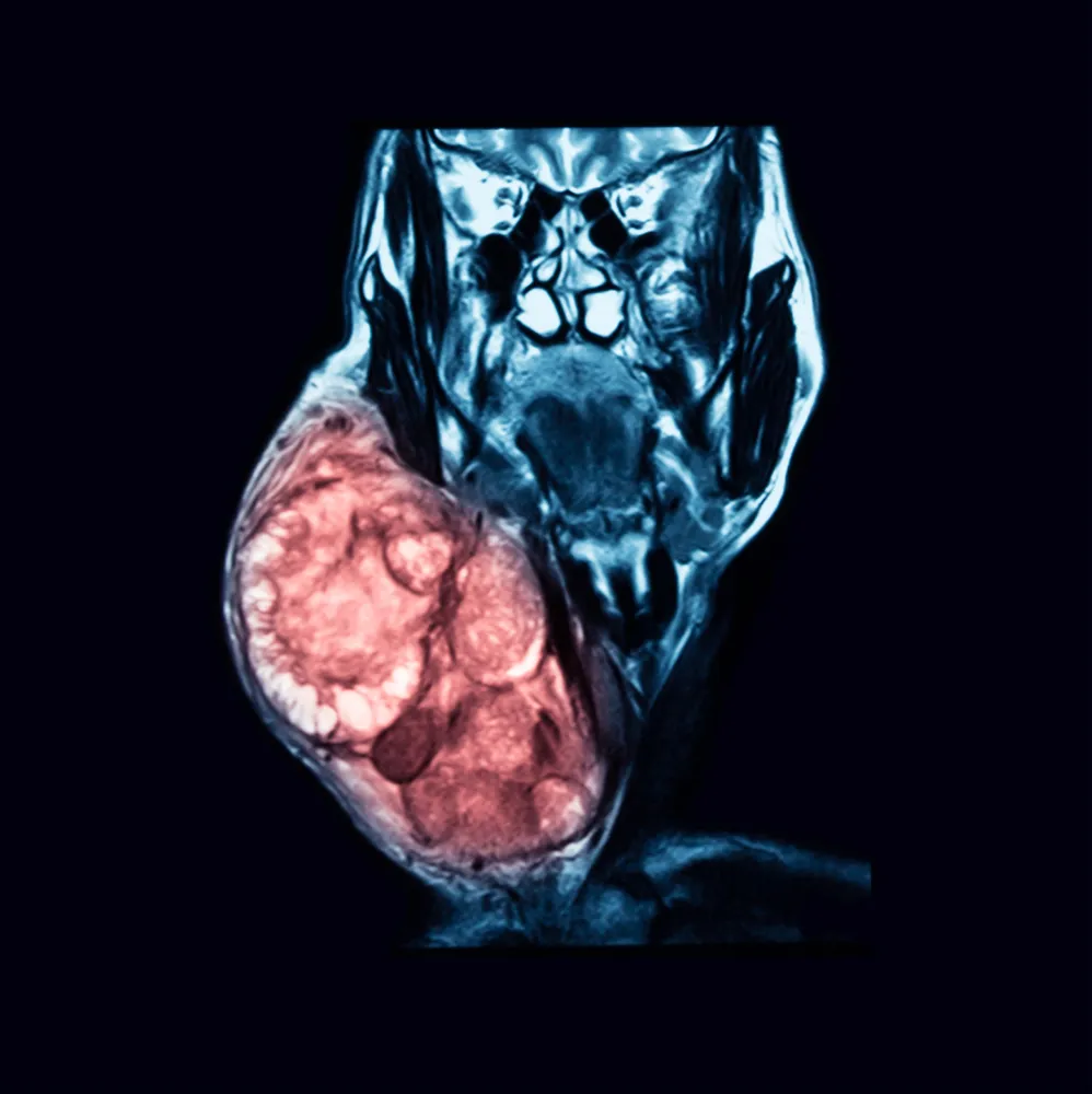 Eye Cancer Treatment in India