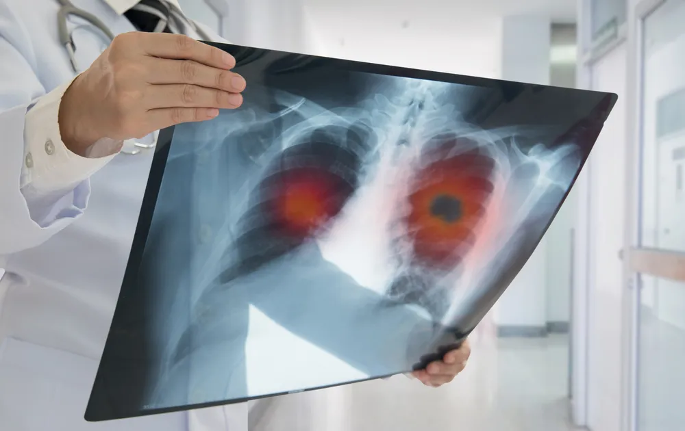 Lung Cancer Treatment in Hyderabad