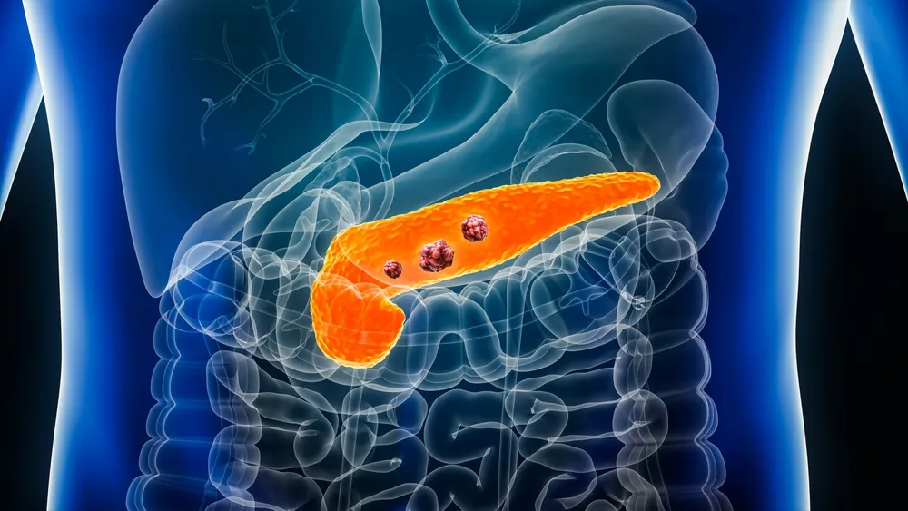 Pancreatic Cancer Treatment in Hyderabad